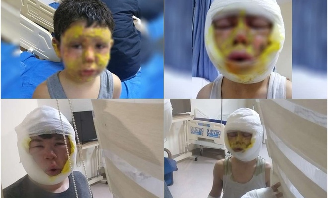 Gaziantep’te mazot tenekesi patladı: 4 çocuk yaralandı