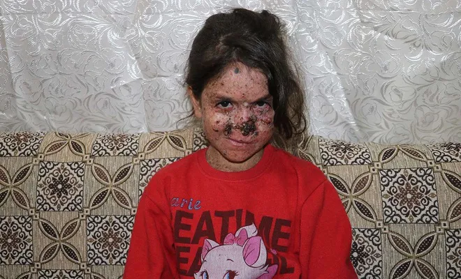 Hastalığına teşhis konulamayan küçük Cemile 5 yıldır güneşe hasret