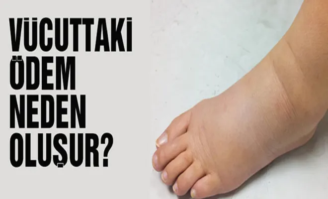 Vücuttaki ödem neden oluşur? Nasıl vücuttan atabiliriz?