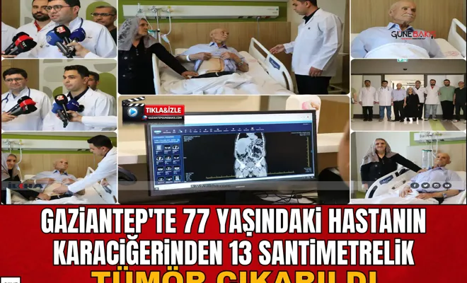 Gaziantep'te 77 yaşındaki hastanın karaciğerinden 13 santimetrelik tümör çıkarıldı